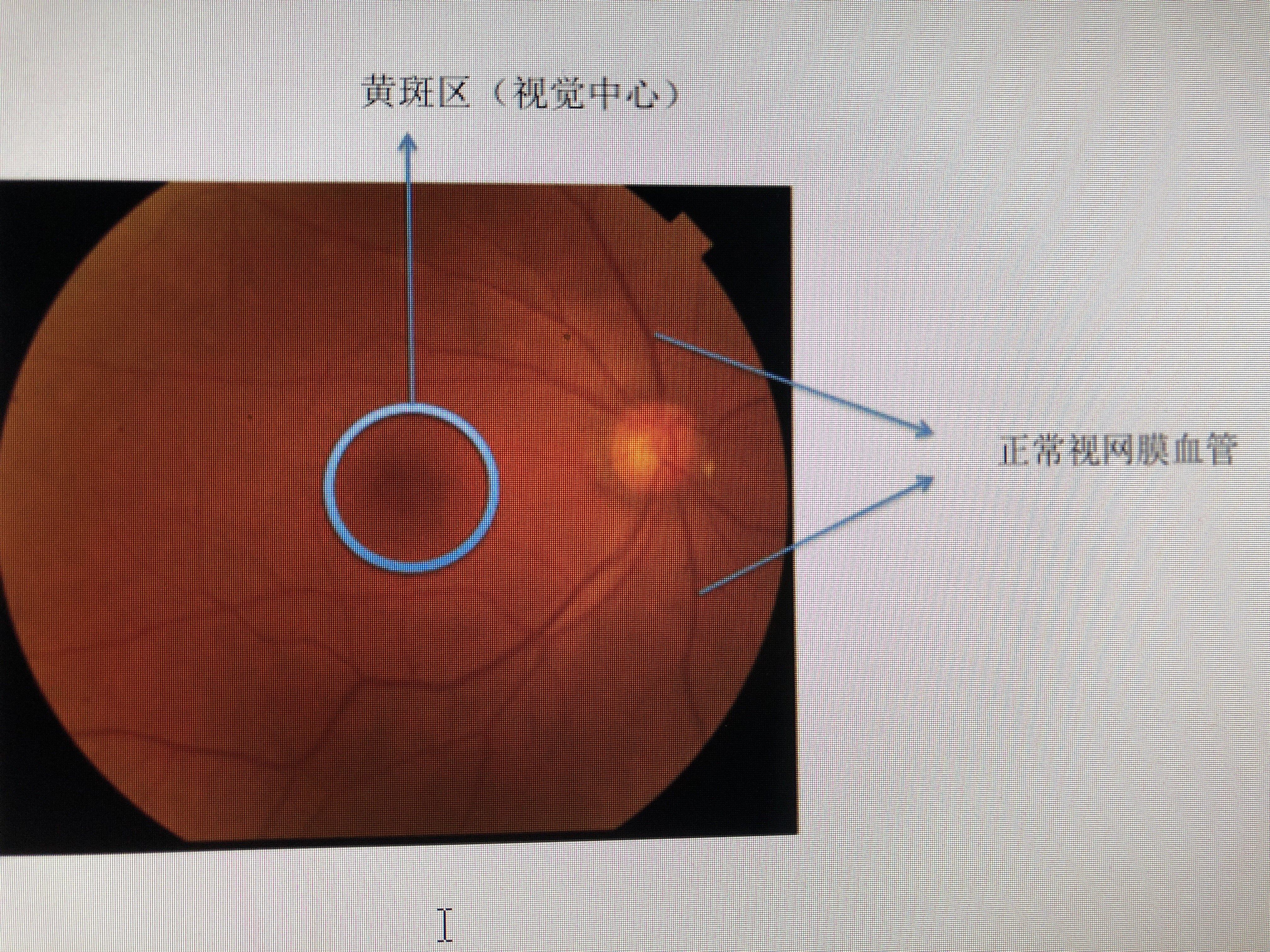窗口,視網膜血管是人體內唯一可以肉眼可見的血管,聚焦到眼底視網膜上