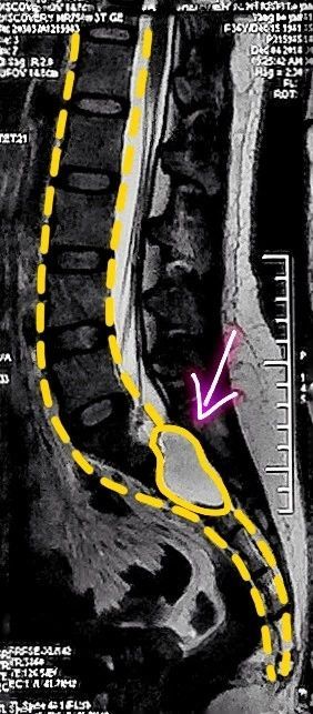 s2水平骶管囊肿图片
