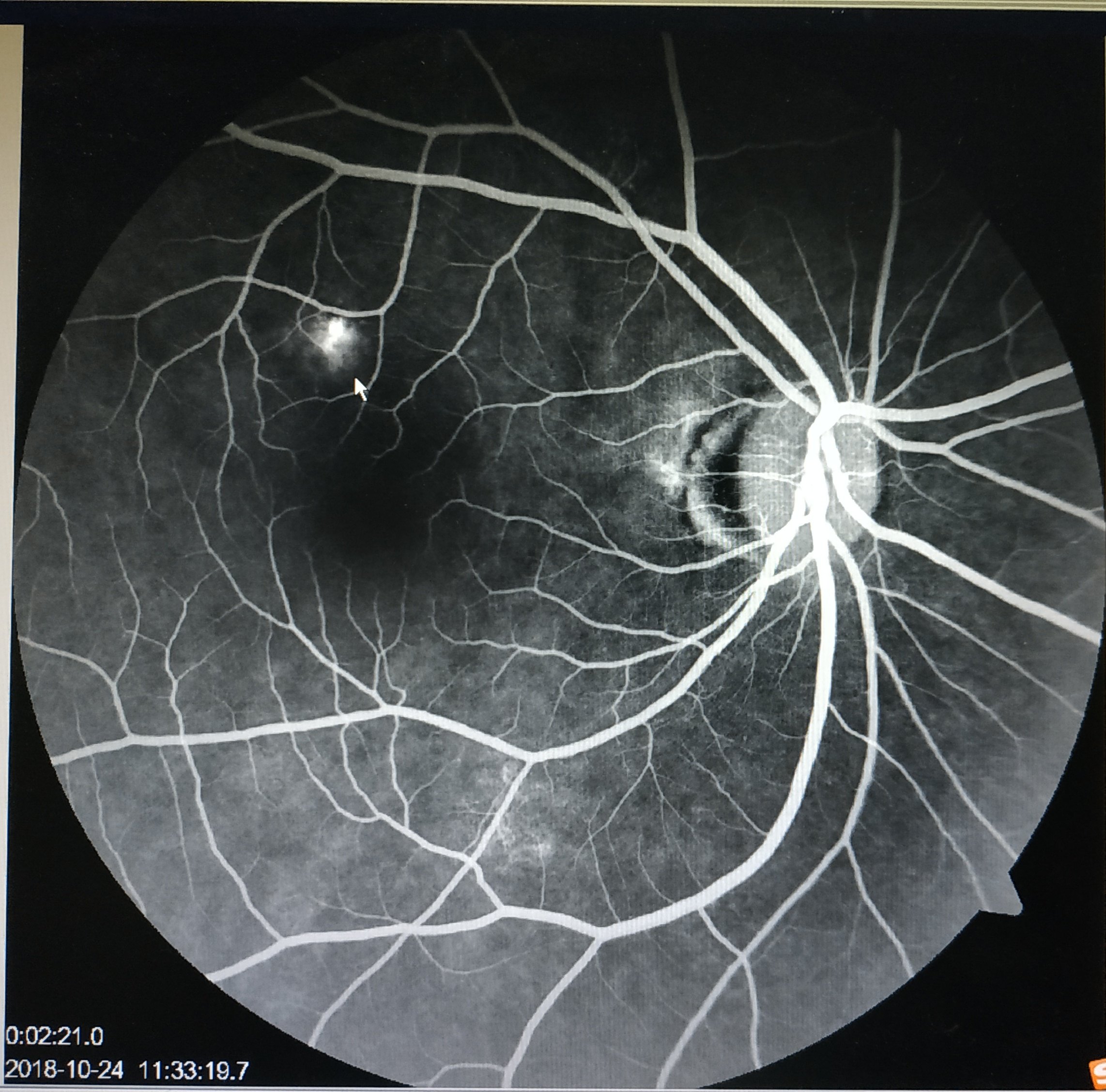 中心性浆液性脉络膜视网膜病变 