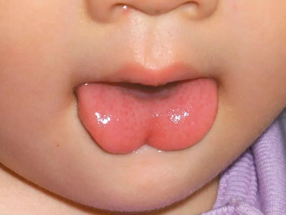 舌系带过短图片宝宝图片