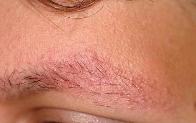 儿童脸上鸡皮肤严重吗(宝宝脸上鸡皮肤病怎么办) 儿童脸上鸡皮肤严重吗(宝宝脸上鸡皮肤病怎么办)