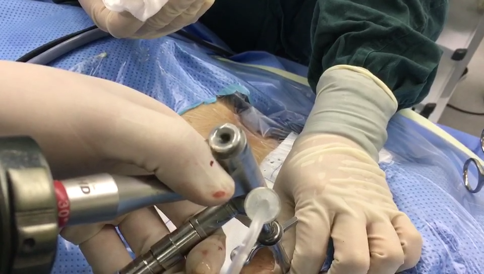 微创技术治疗脊柱结核 - 好大夫在线