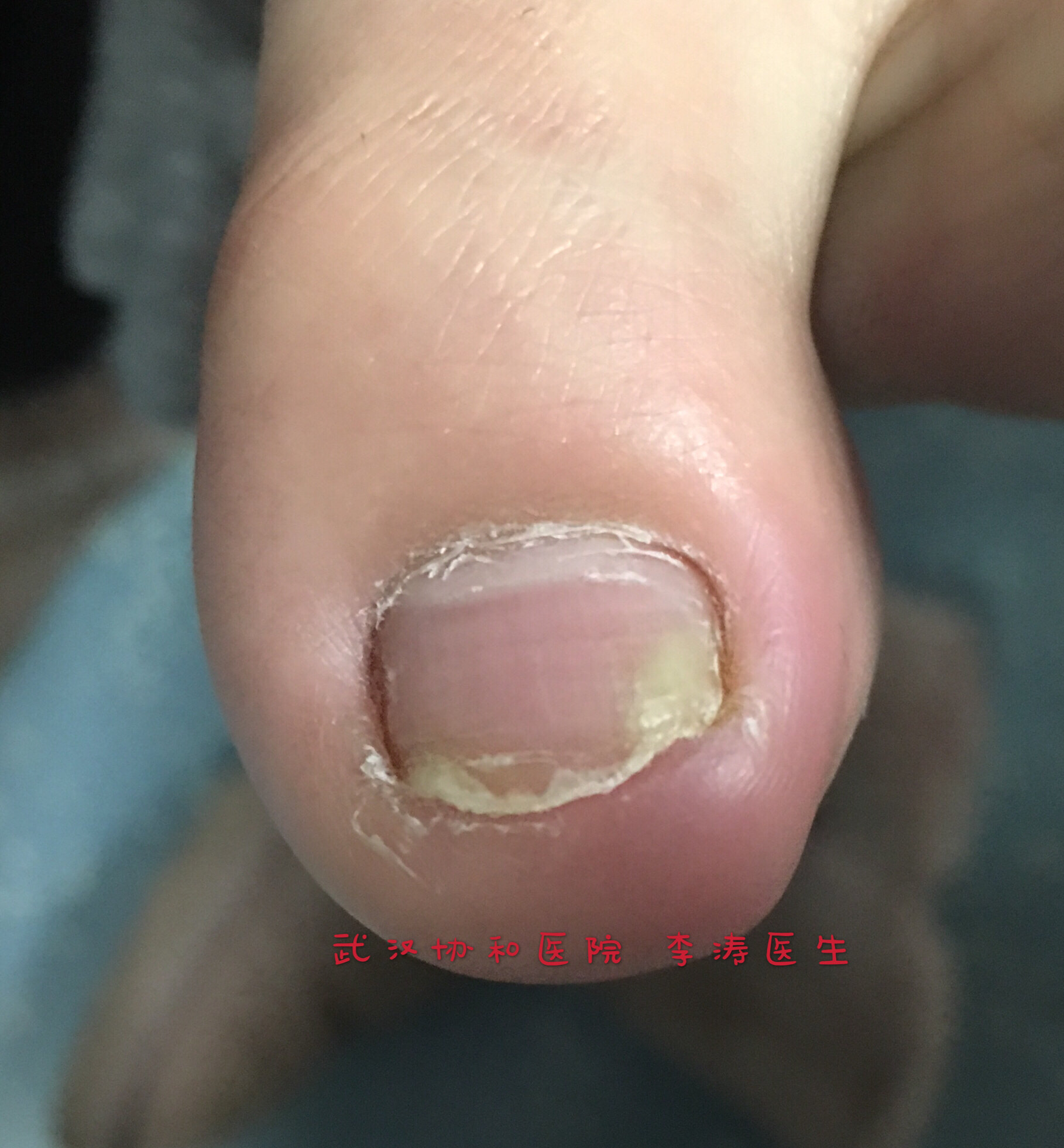 脚趾甲沟炎的症状图片图片