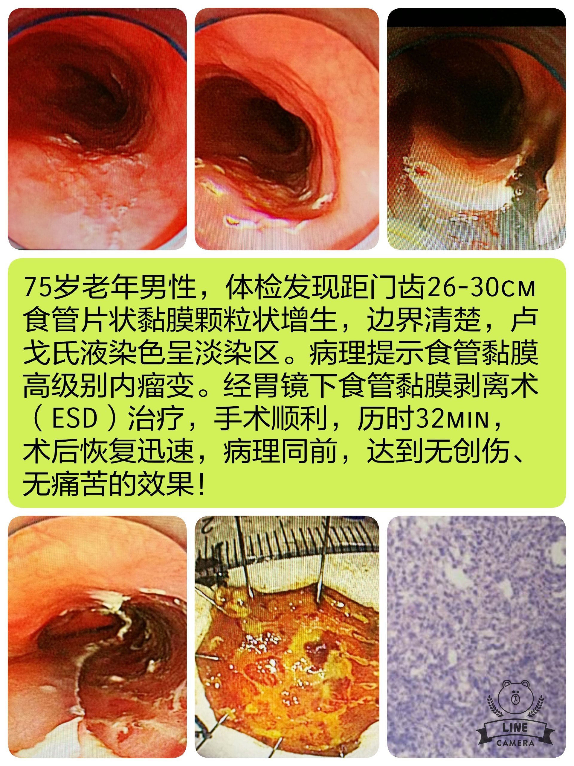 食管早癌內鏡下治療 - 好大夫在線