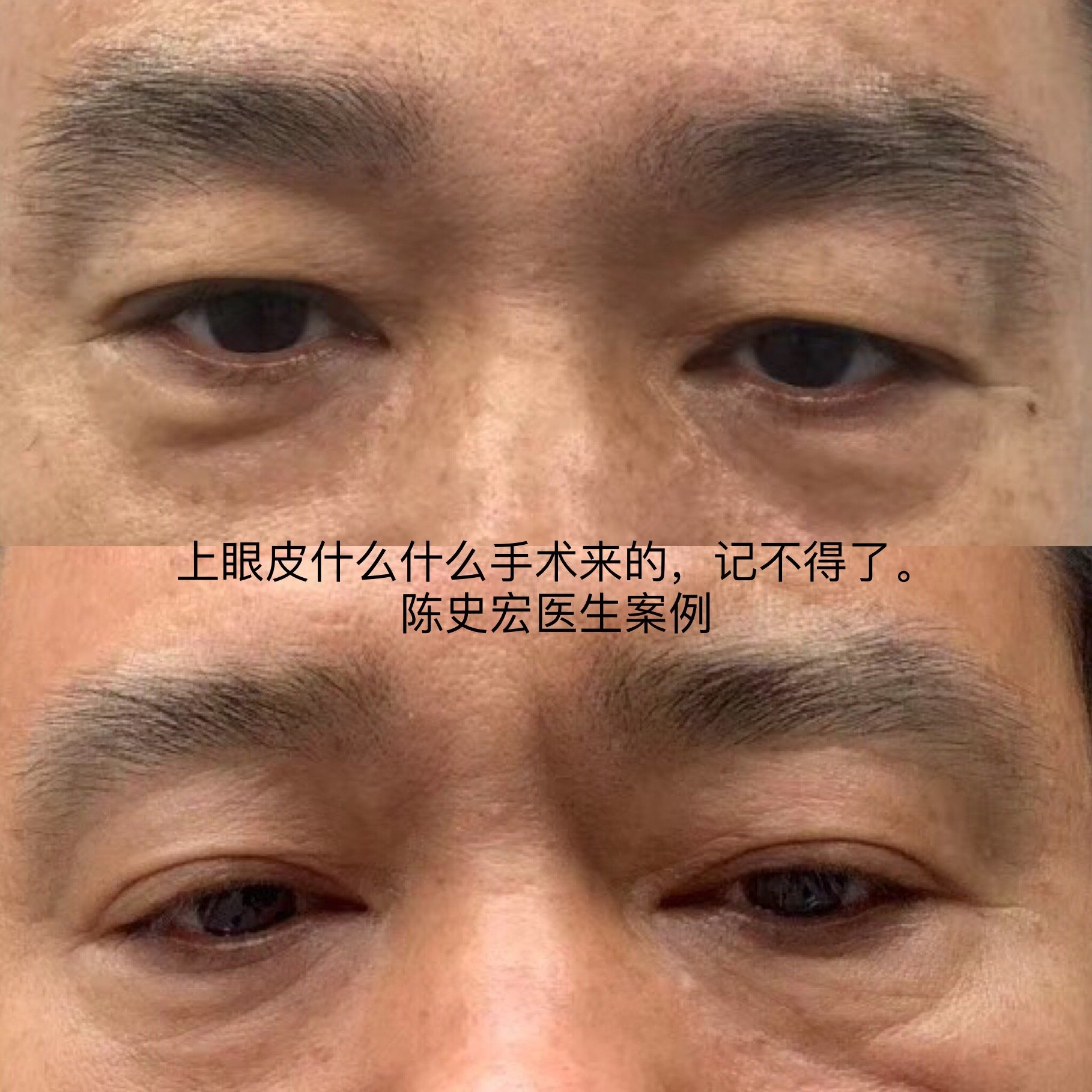 眼皮松垂手术治疗 - 好大夫在线