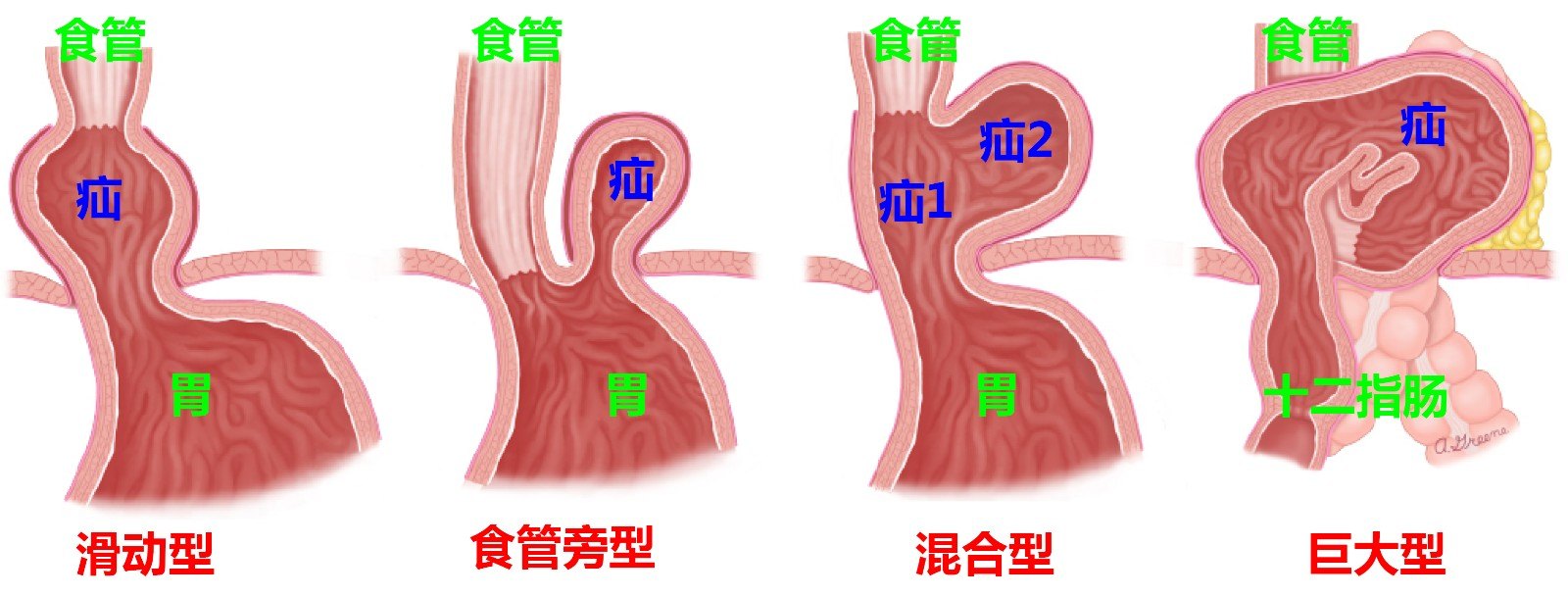 UTD 食管裂孔疝分型.jpg