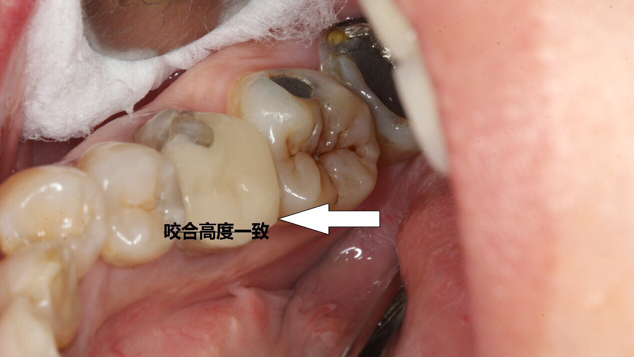 病例三图1 男  45岁,食物嵌塞困扰2年,该图片可