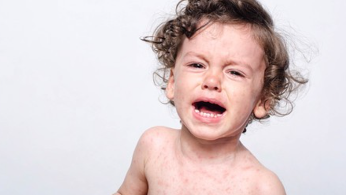 小儿荨麻疹怎么治疗