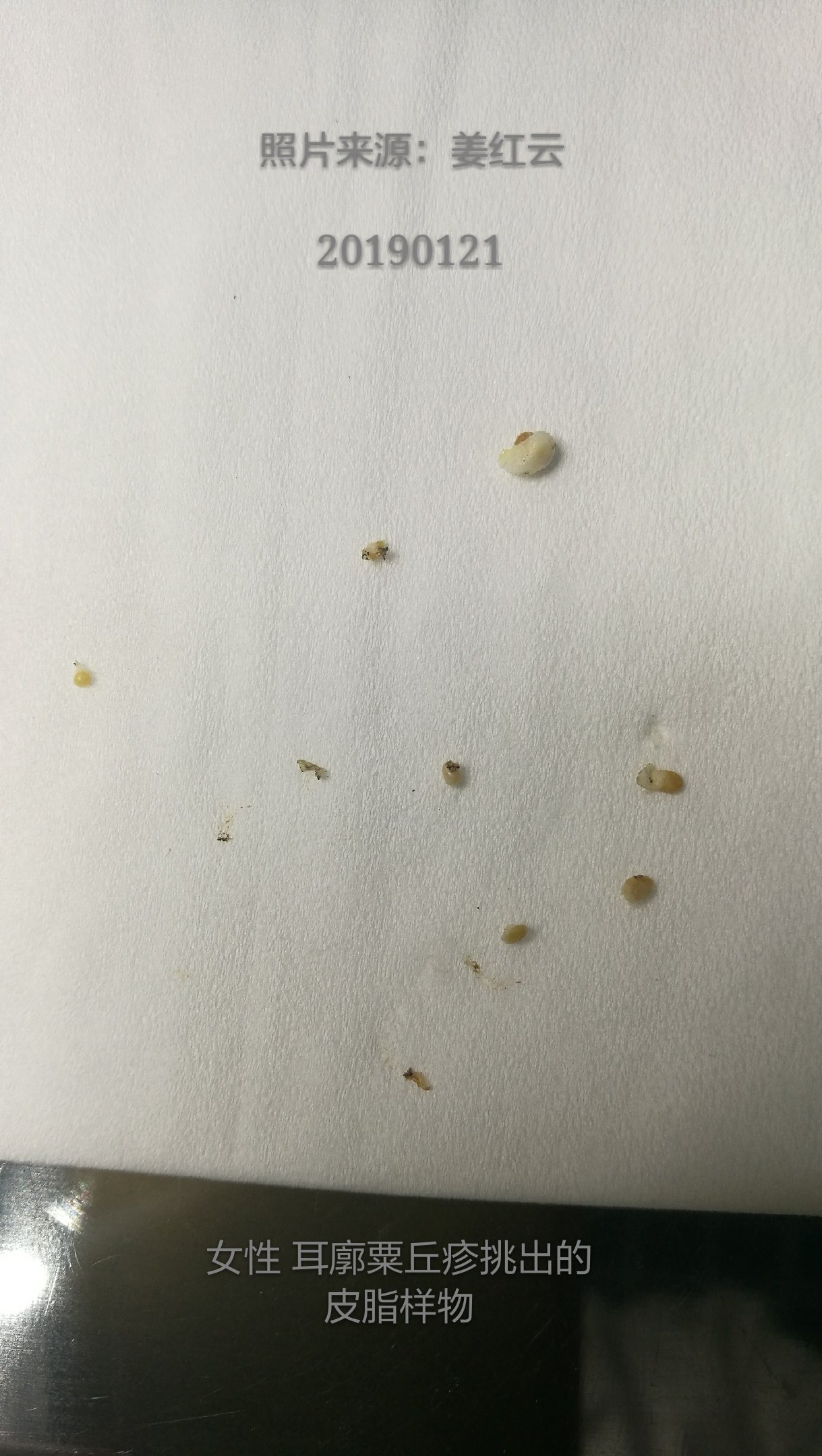 长在耳廓的一例粟丘疹: - 好大夫在线