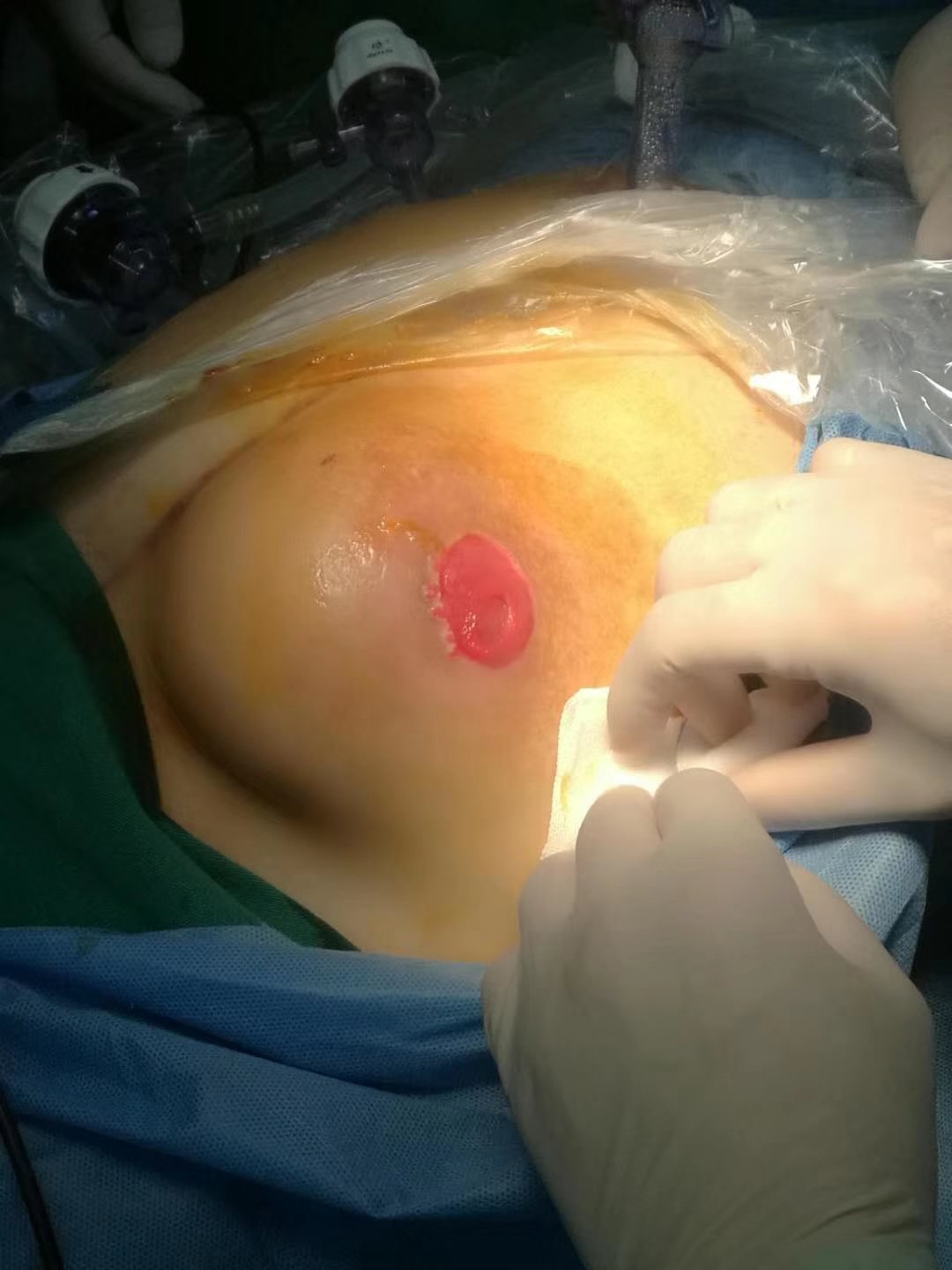 阑尾炎术后切口疝图片图片