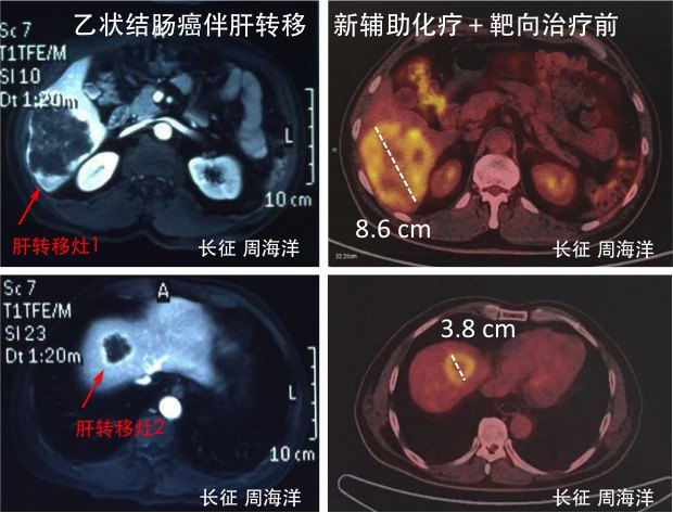 结肠癌肝转移新辅助治疗典型病例 - 好大夫在线