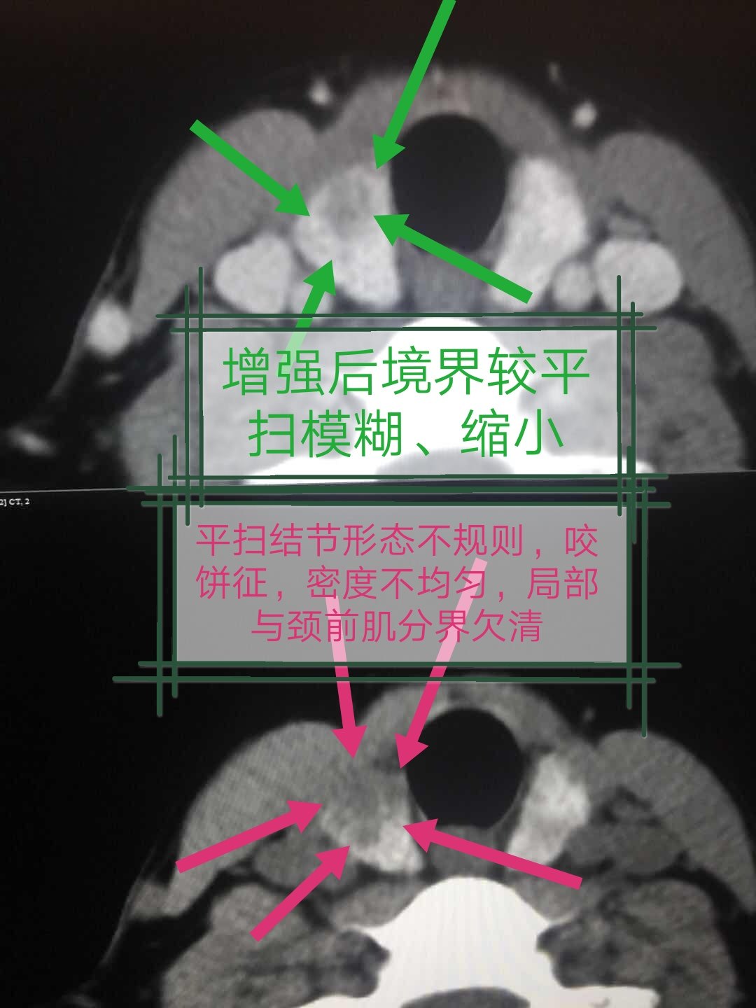 甲状腺ct扫描范围图像图片