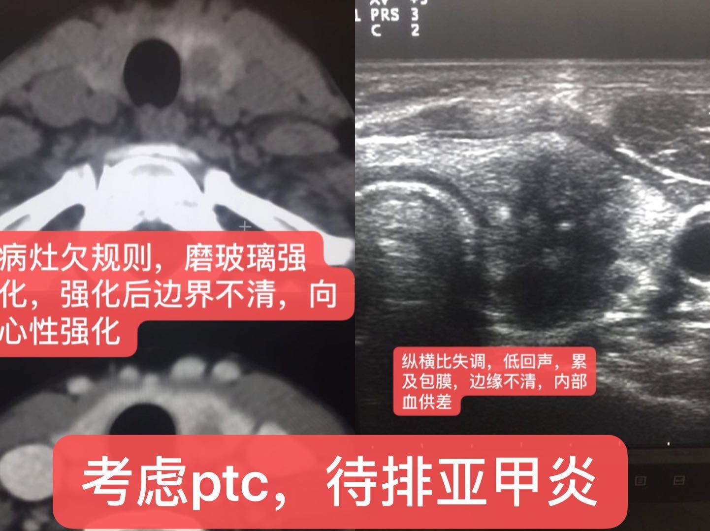 亚甲炎超声表现图像图片