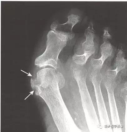 尿酸盐结晶在软组织内聚集形成痛风石,这是痛风的晚期改变,鲜有钙化.
