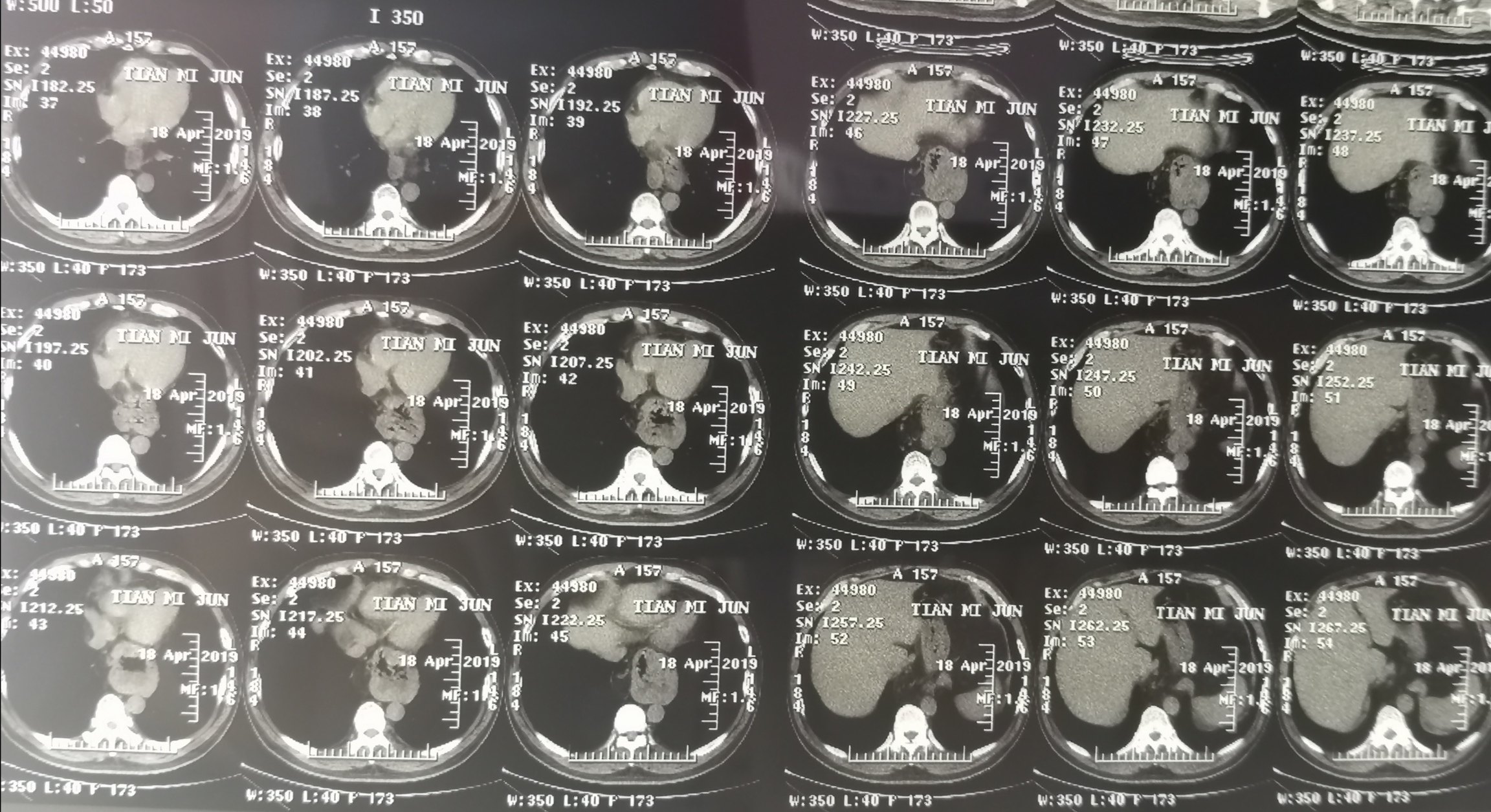 哈医大二院胸外科经典病例之食管裂孔疝