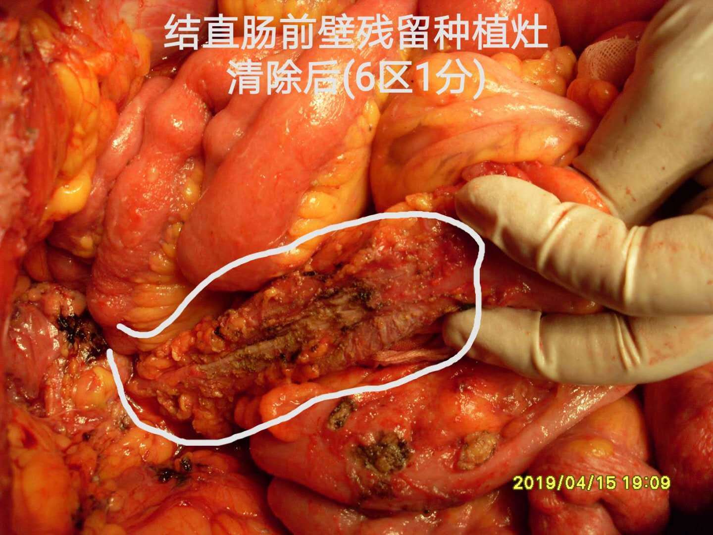 而血cea正常)无明显果冻及粘液颗粒,大网膜成饼,盆腔腹膜,侧膜,膈肌