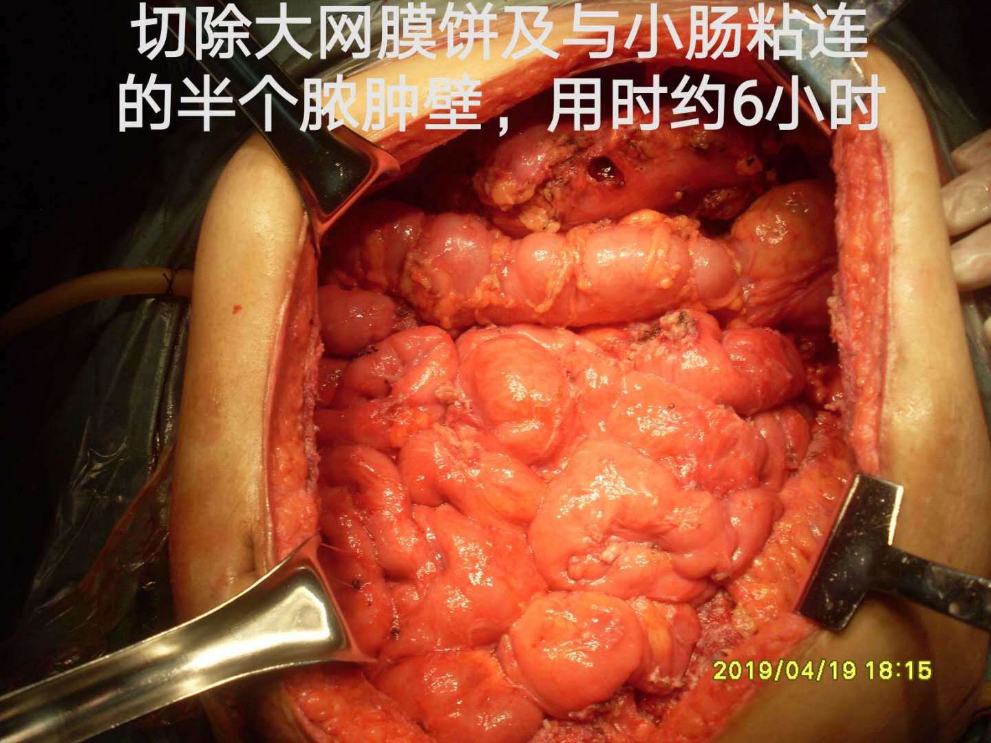 9 手术路线:大网膜饼像大锅盖正面无法进腹,依据平时切除大网膜饼的