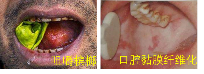 口腔黏膜纤维化:口腔黏膜纤维化常发生在后牙垫区及颊黏膜,嚼食槟榔是