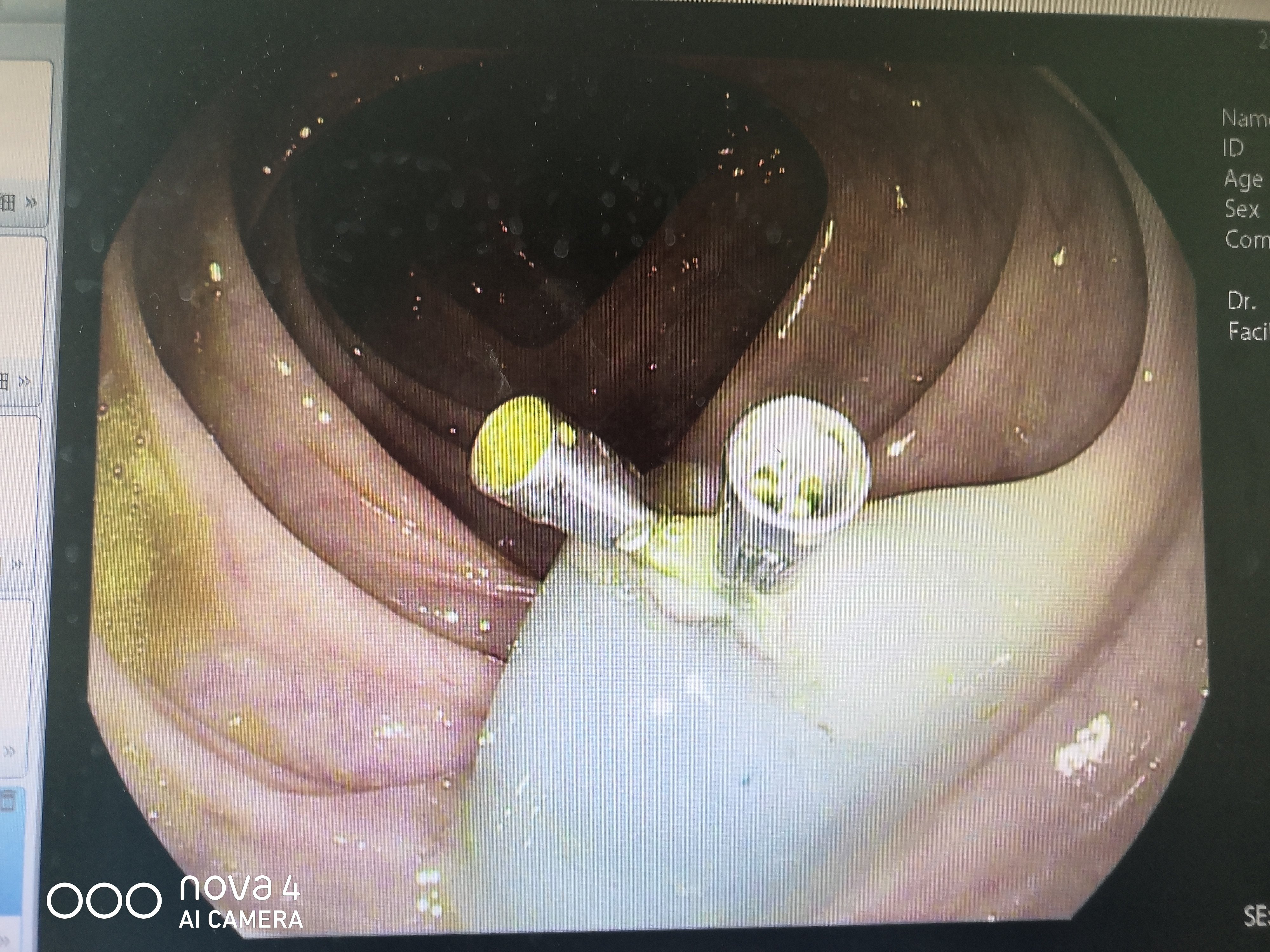 消化内镜微创治疗:结肠巨大息肉切除术1例 - 好大夫在线