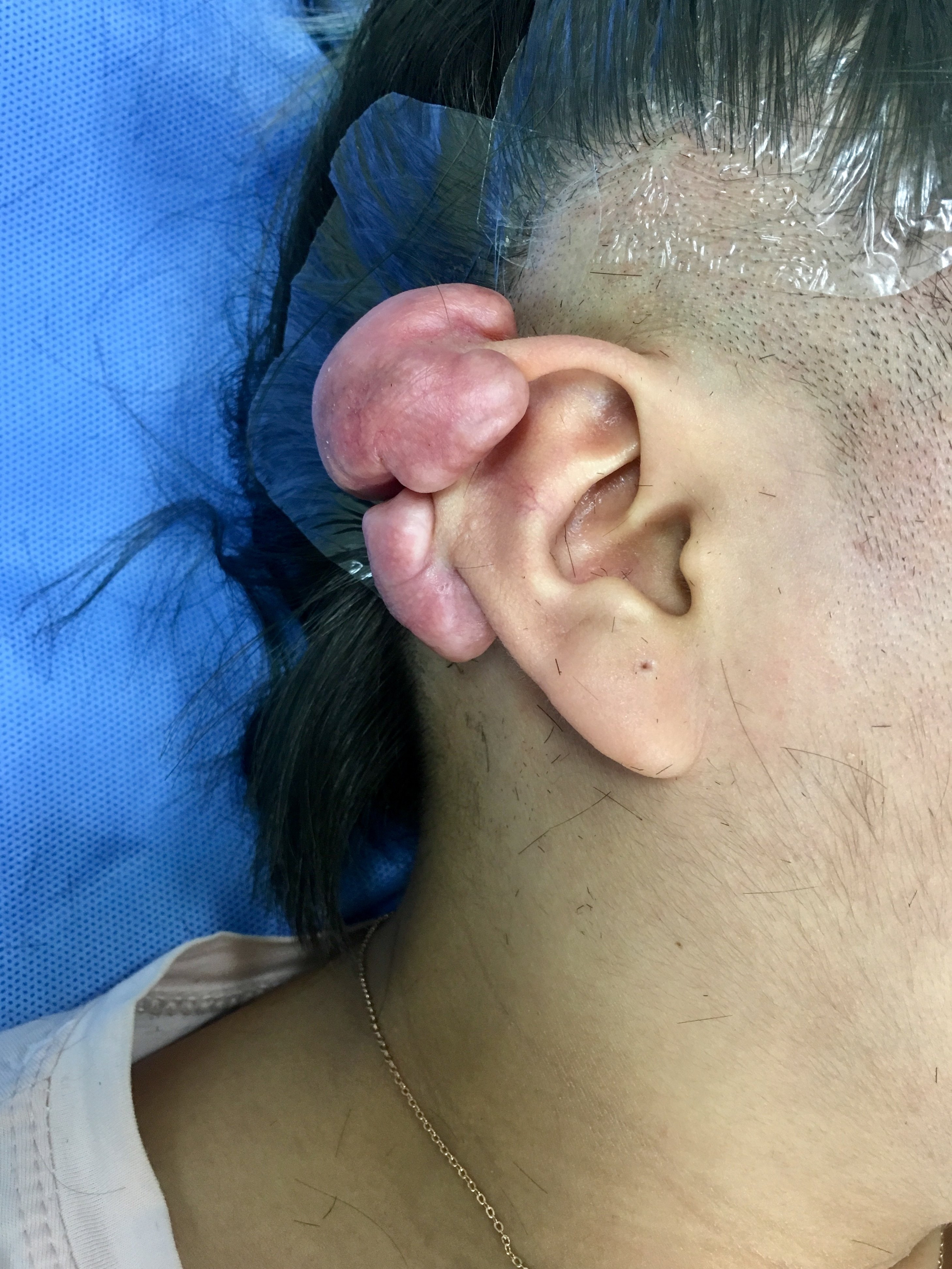 难治性双侧耳廓瘢痕疙瘩的手术治疗