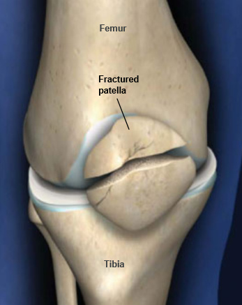 patella-fracture.png