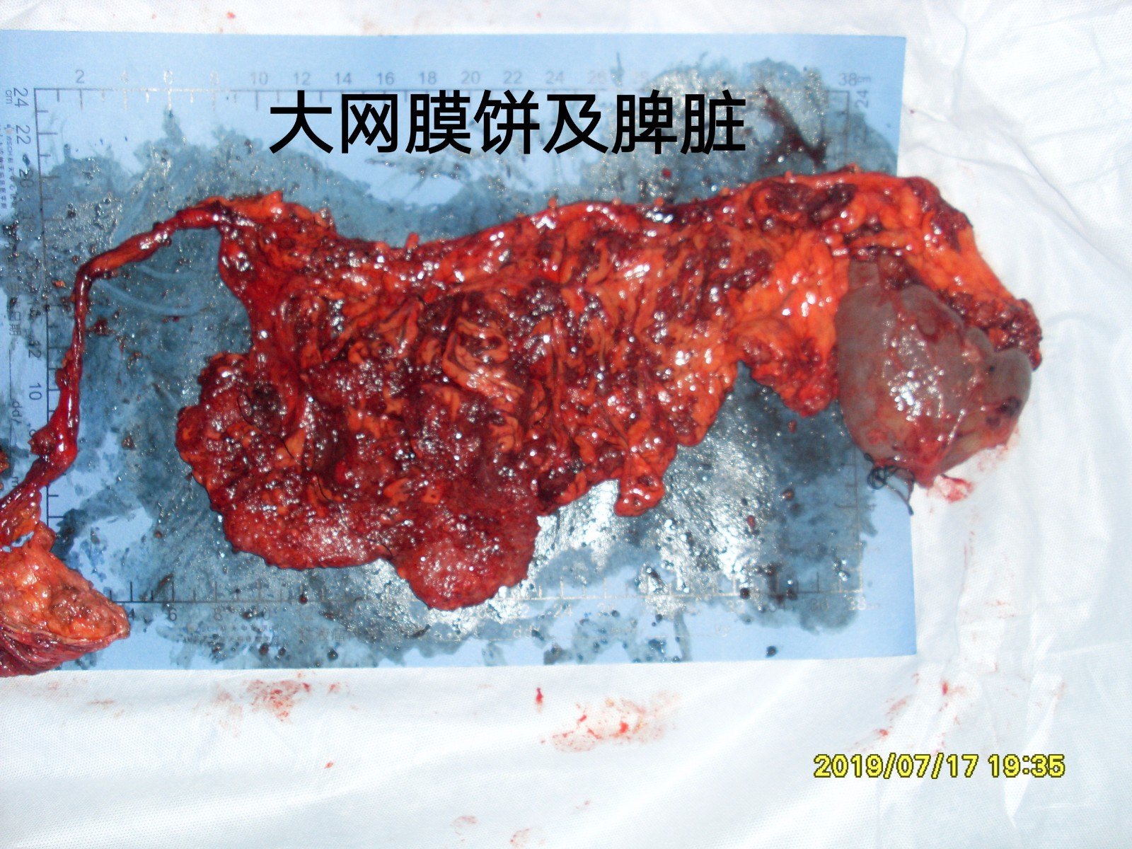 双侧侧腹膜,盆腔腹膜,子宫双附件,douglass窝,阑尾,全大网膜,脾脏,小