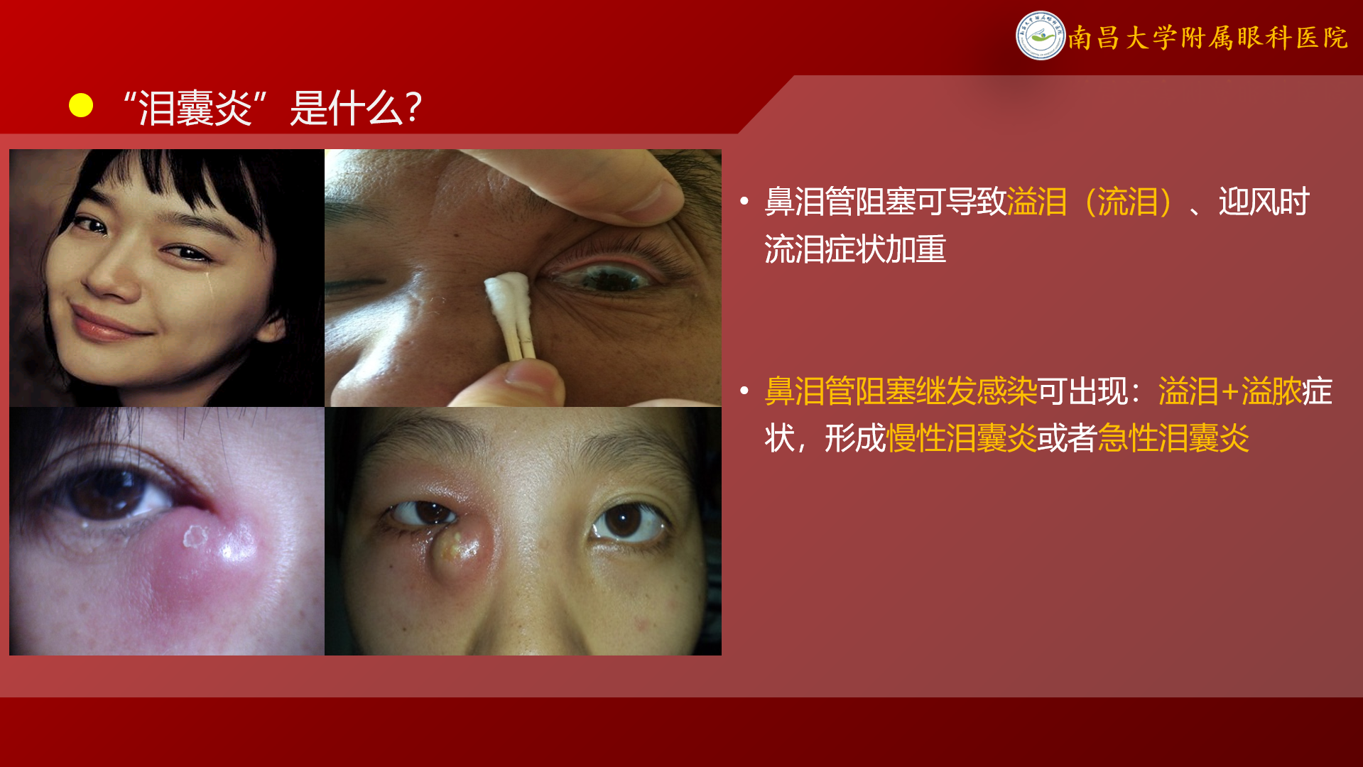 “泪囊炎”如何治疗? - 好大夫在线