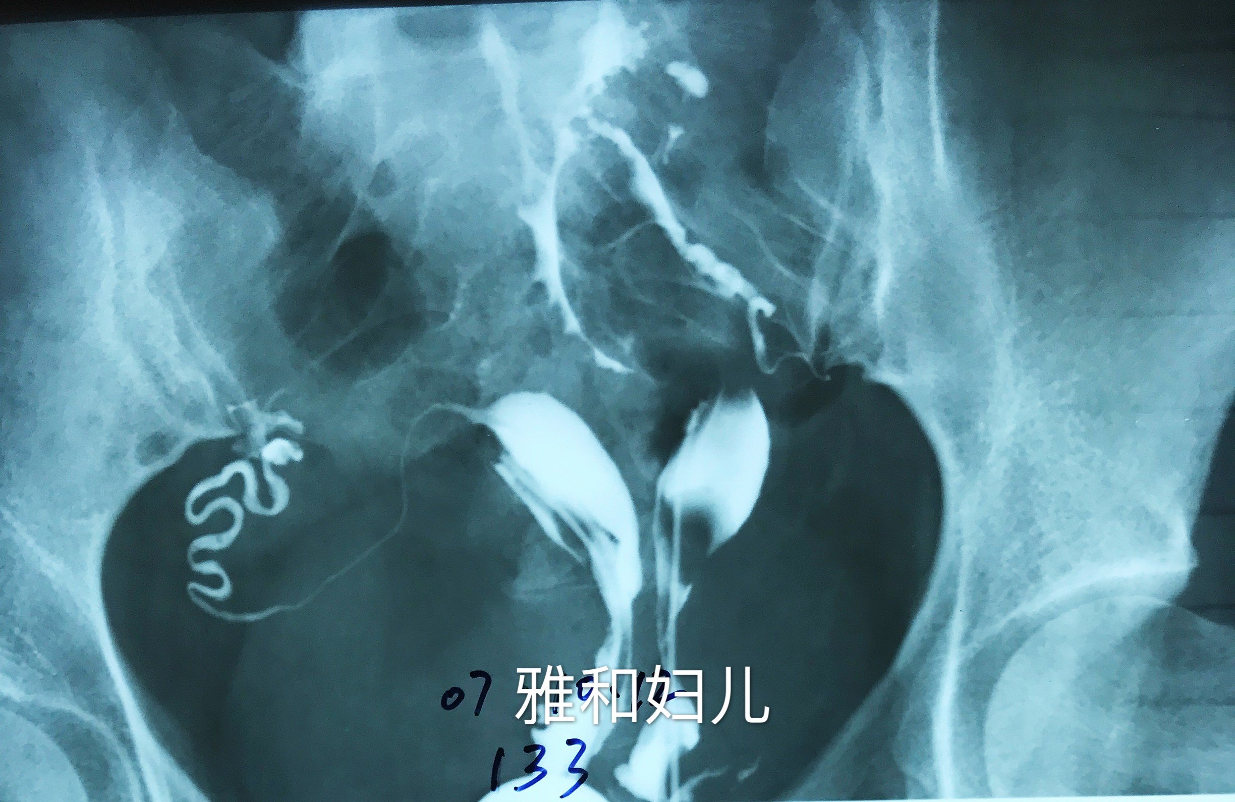 解决大问题的小手术——实时动态子宫输卵管碘油造影术_不孕症_检查