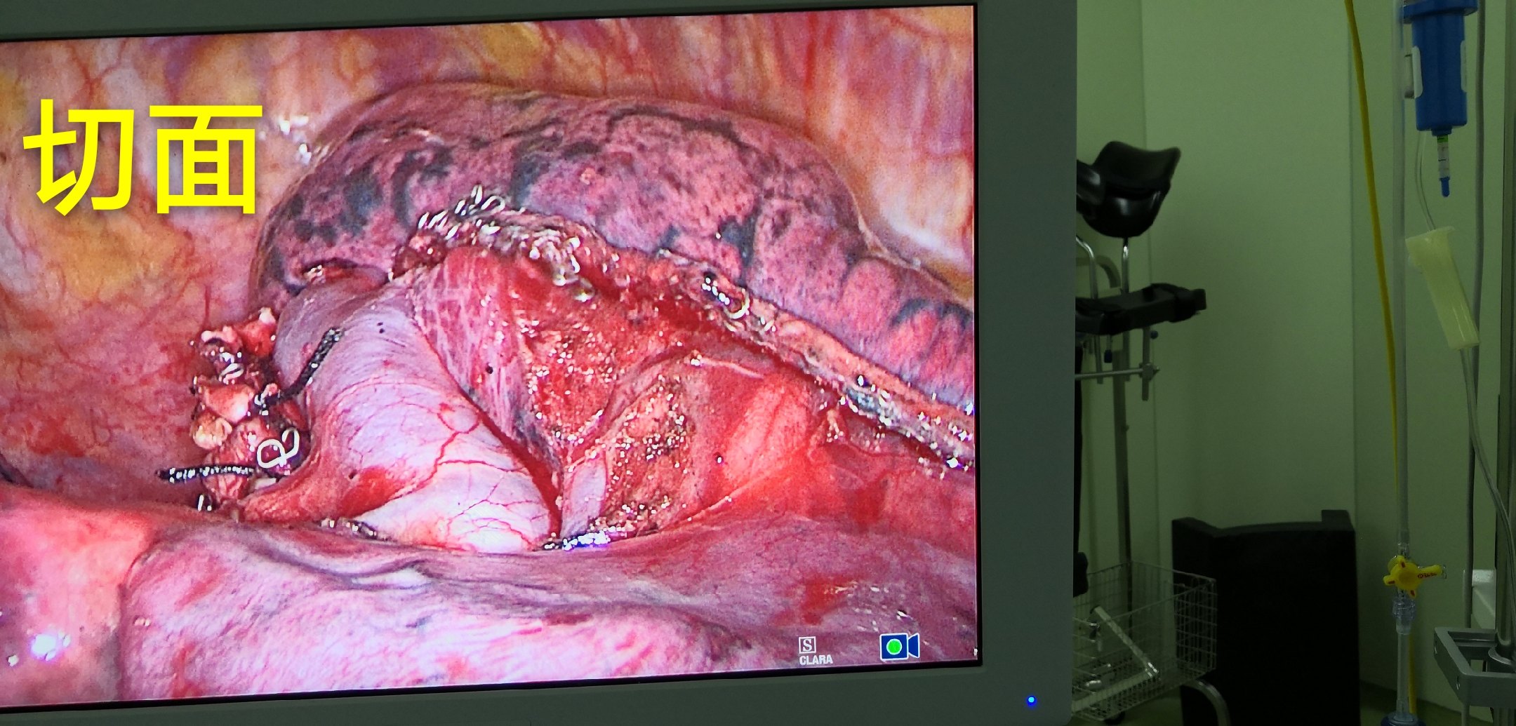 哈医大二院胸外科经典病例之胸腔镜下右肺s2切除术 - 好大夫在线