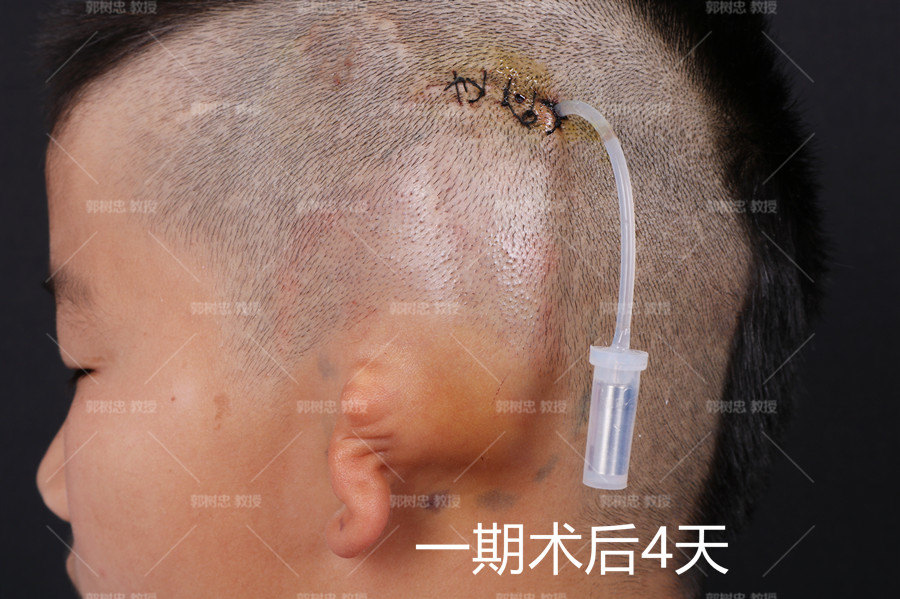 耳再造手术的细节(一)埋置扩张器的切口