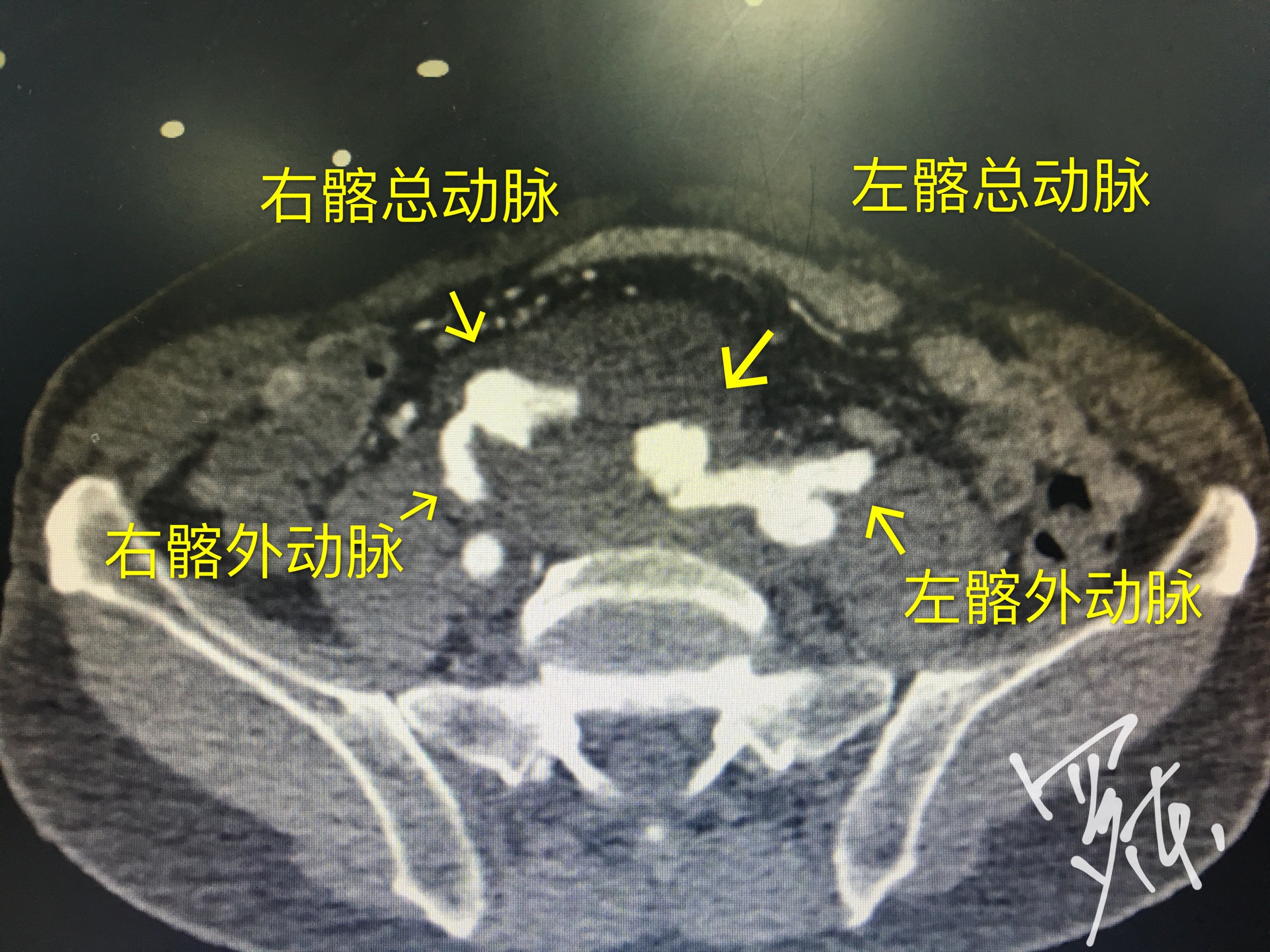 髂动脉CT解剖图图片