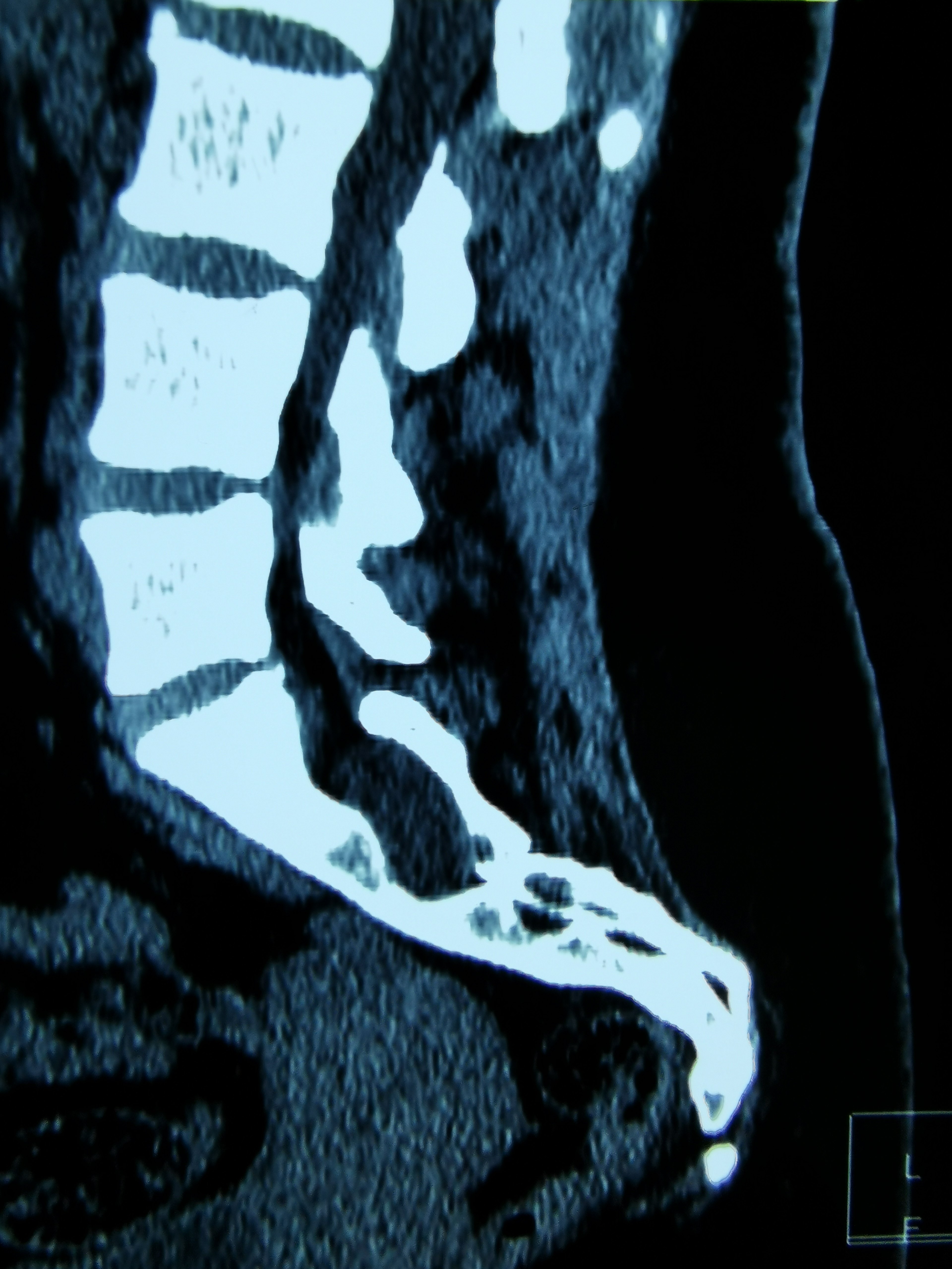 腰骶部疼痛,椎间盘突出作怪?_骶管囊肿_介绍_症状表现_治疗方式 - 好