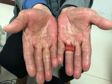 舒鹏教授治疗靶向药物治疗后手足综合征验案一则 - 好大夫在线