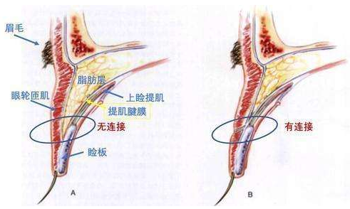 反之,眶隔与上睑提肌腱膜融合位置较低(如图a),无法形成粘连结构,睁眼
