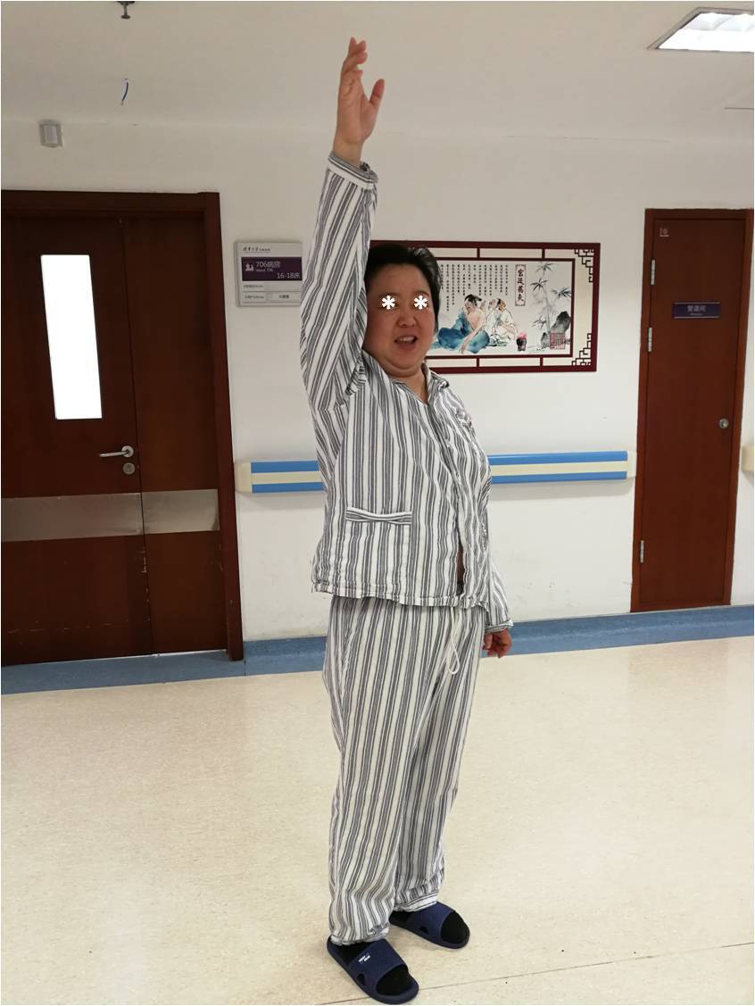 女,45岁,因"突发右侧肢体活动障碍伴语言障碍近1个月",以"高血压脑