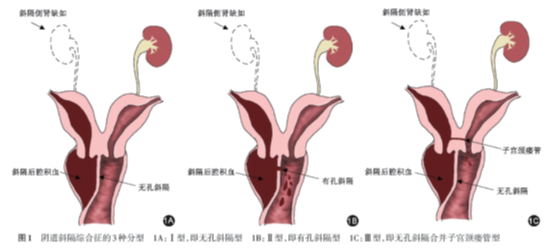 阴道斜隔综合征是指存在两个子宫,两个宫颈及阴道斜隔的先天性畸形,常