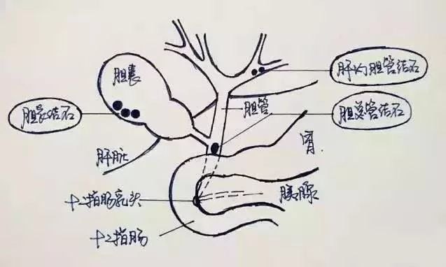 几张图告诉你胆结石就那么回事