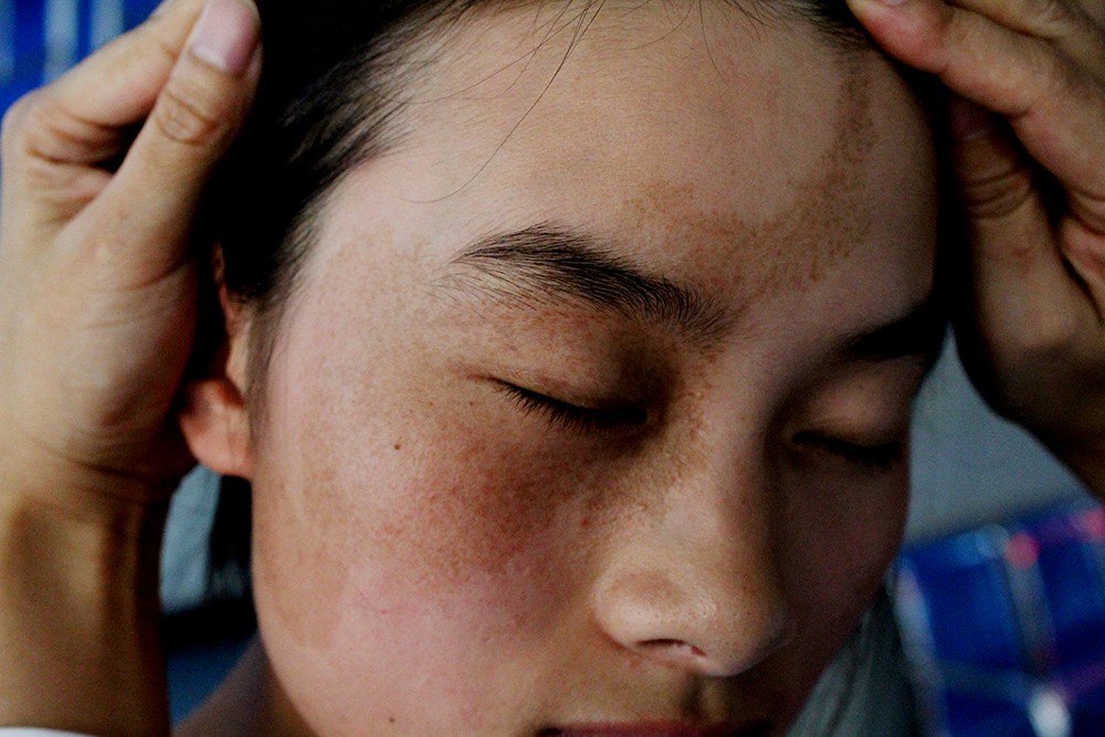 《邓主任胎记大课堂》之:青胎记(祛斑)治疗,"反黑"现象 - 好大夫在线