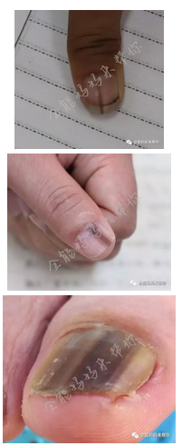指甲隆起是什么原因图片