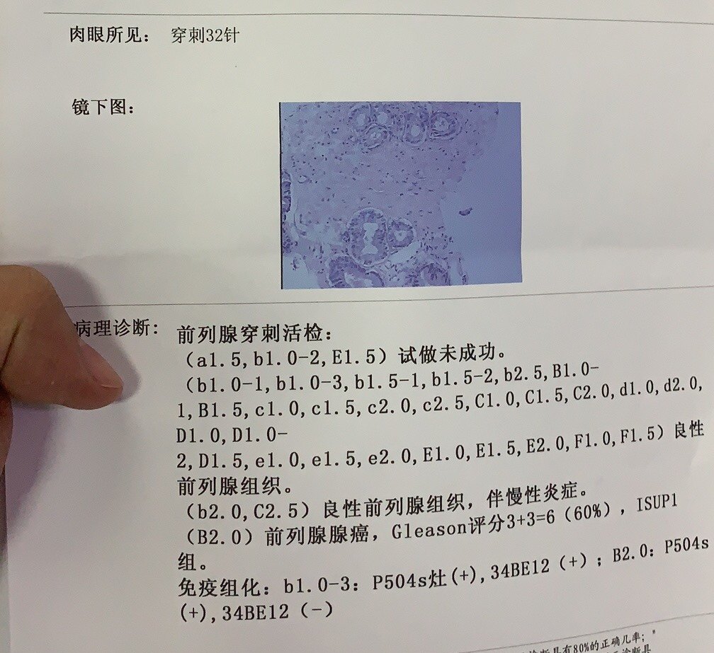 前列腺癌精准穿刺—避免漏诊 - 好大夫在线