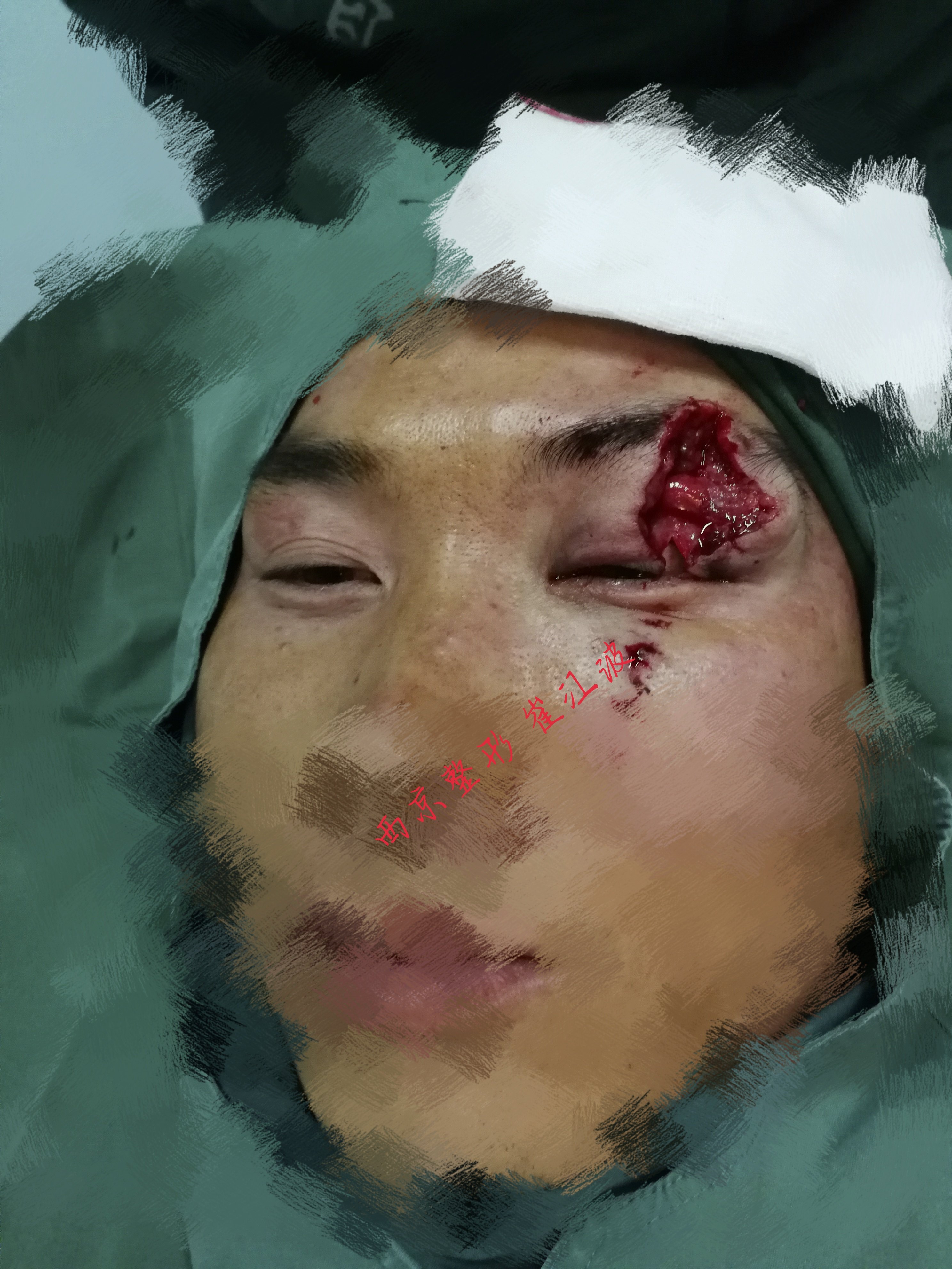 面部外伤美容缝合