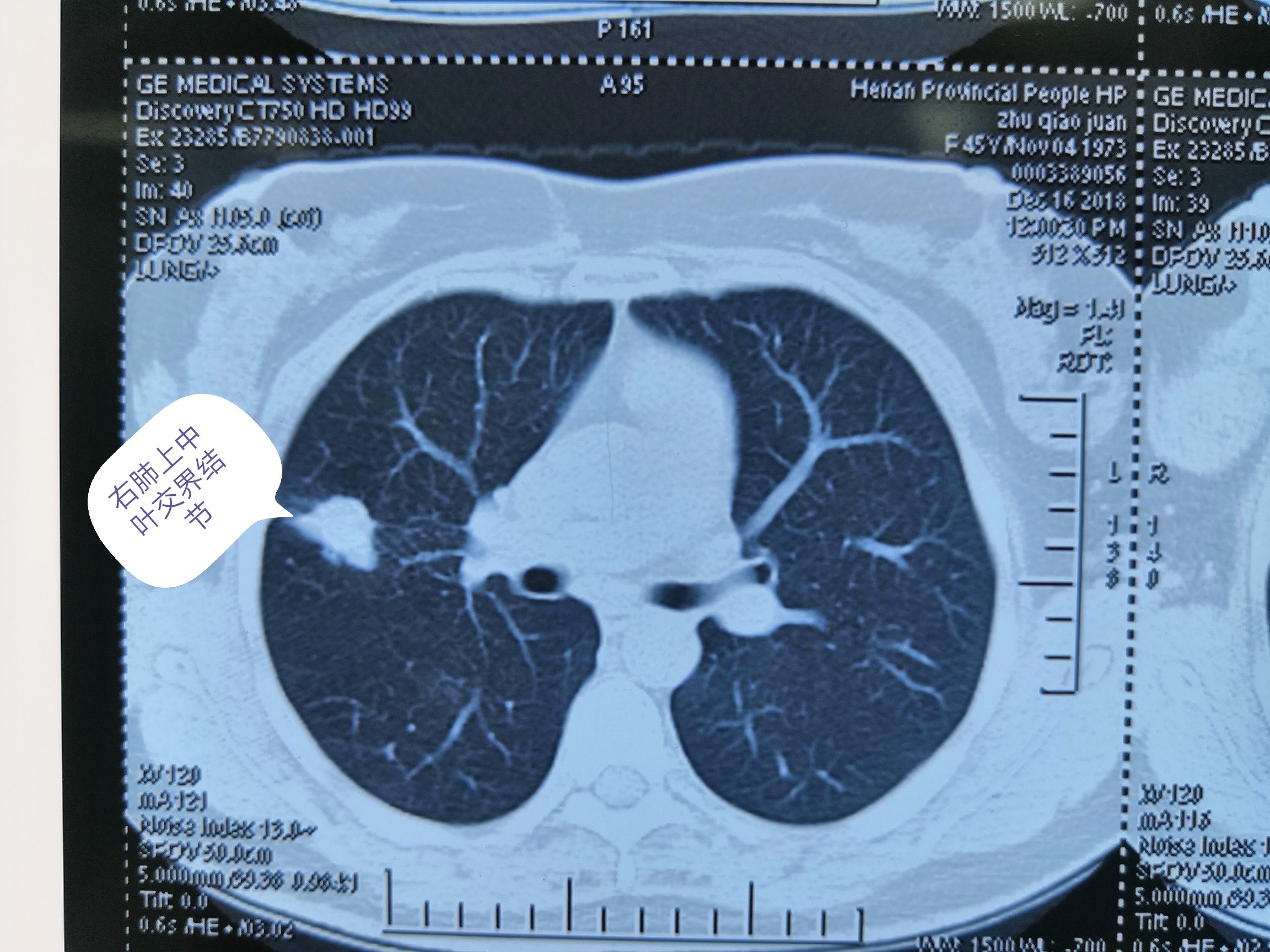 右肺上叶中叶交界结节腺癌胸腔镜右肺上叶中叶切除