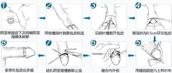 40岁男人包茎长的危害图片