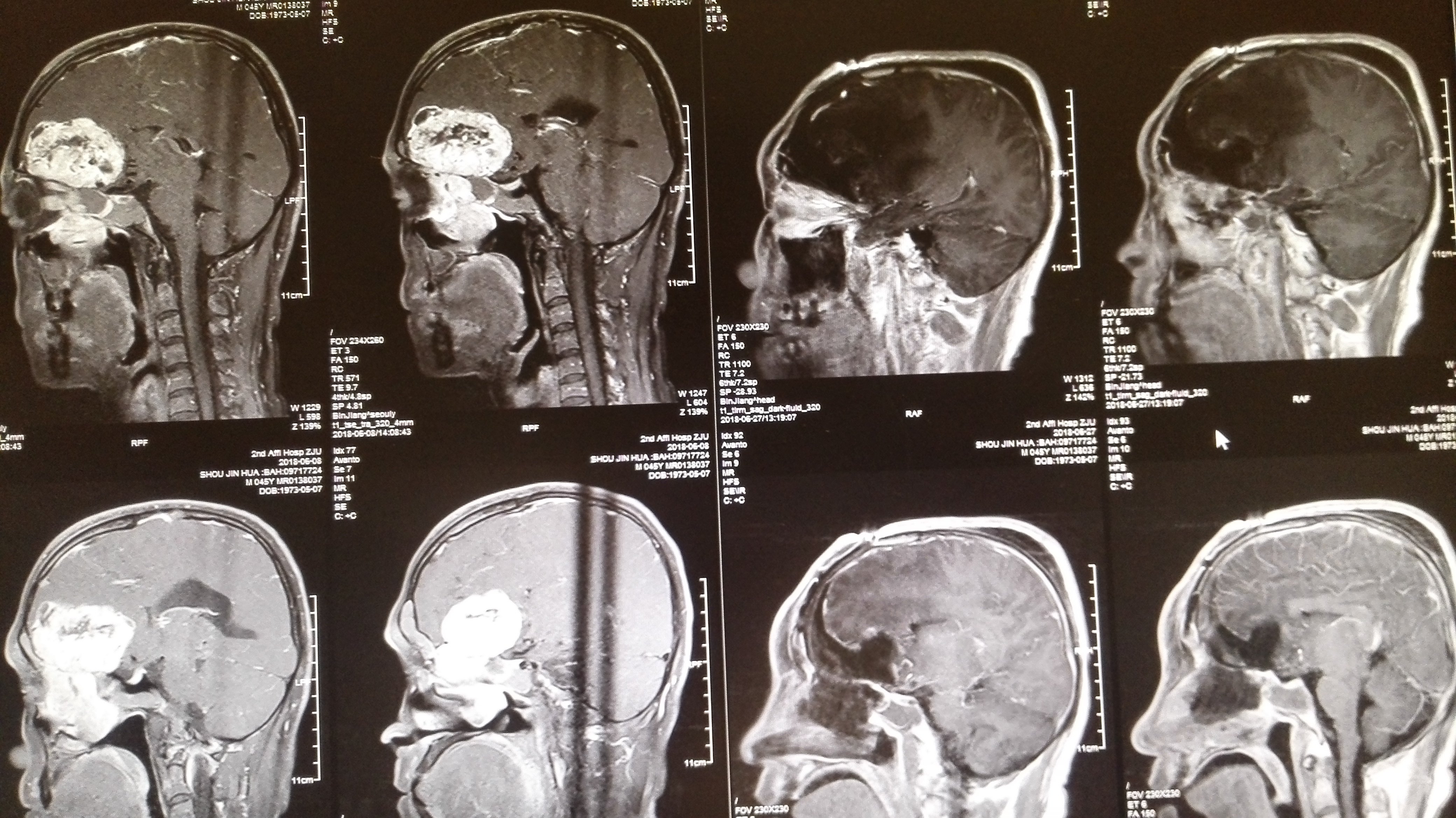神经母细胞瘤晚期图片