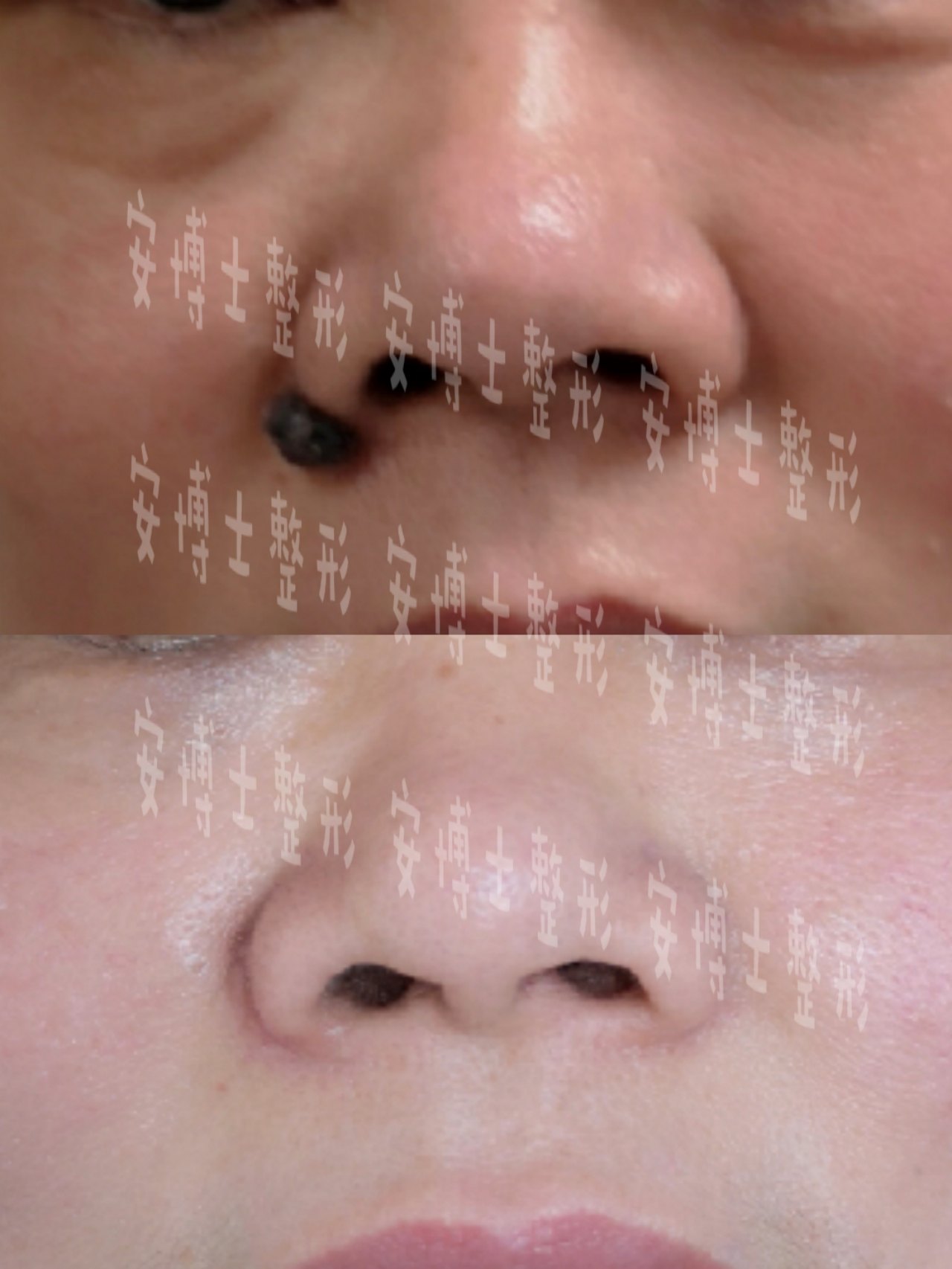 血管瘤黑痣癌变_脚底黑痣癌变_黑痣癌变图片