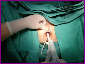 血栓性外痔手术过程图图片
