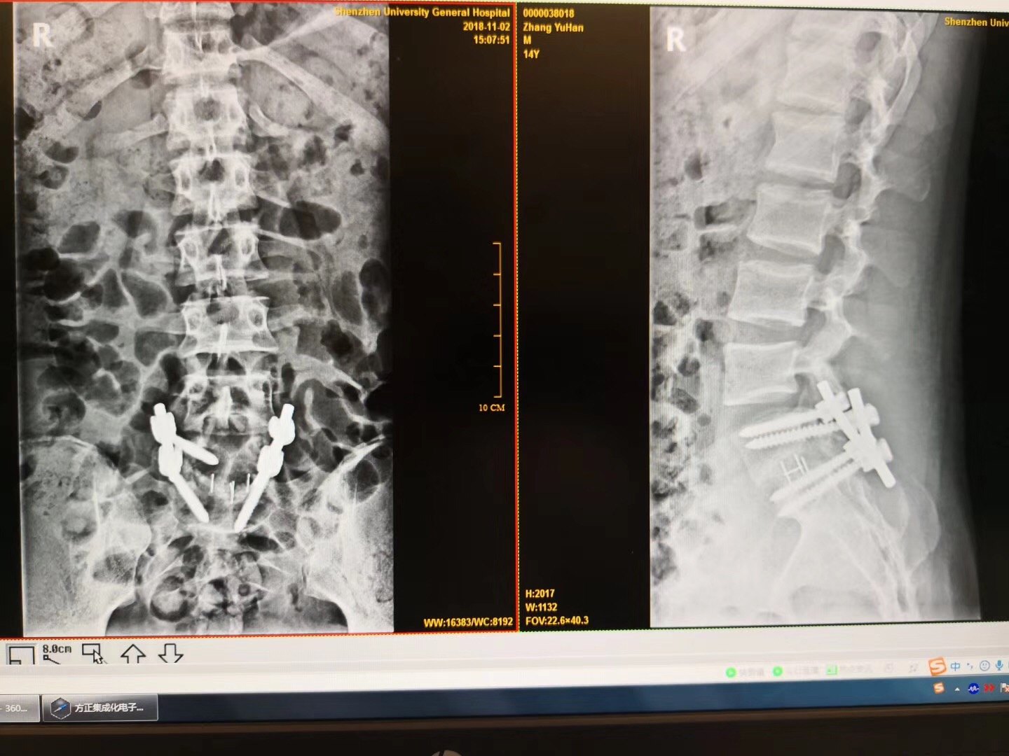 案例少年腰椎滑脫症治療腰椎疾病不是老年人的專利