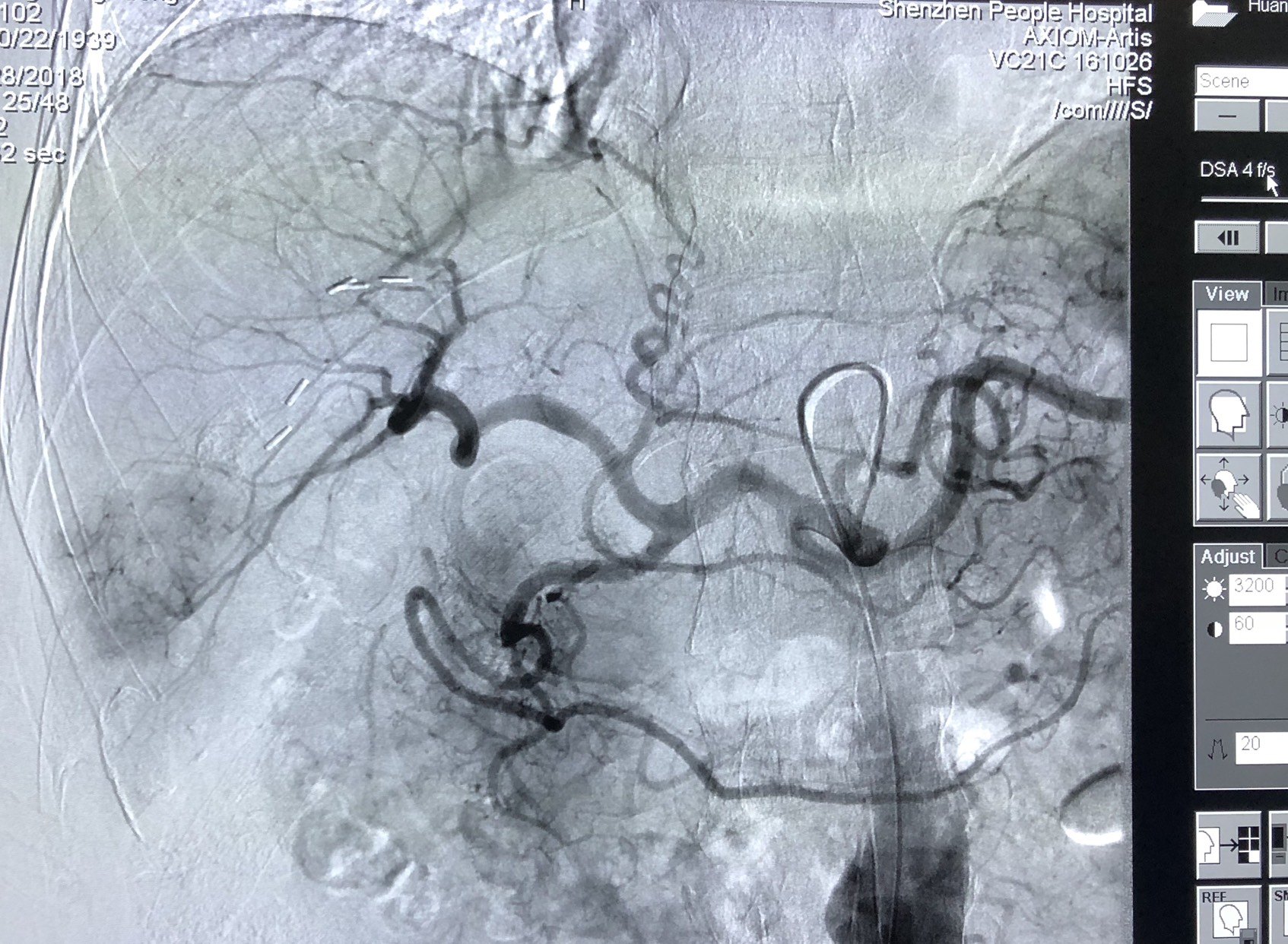 案例2,老年男性,未口服靶向药物,肝动脉造影右肝肿瘤染色,介入栓塞后