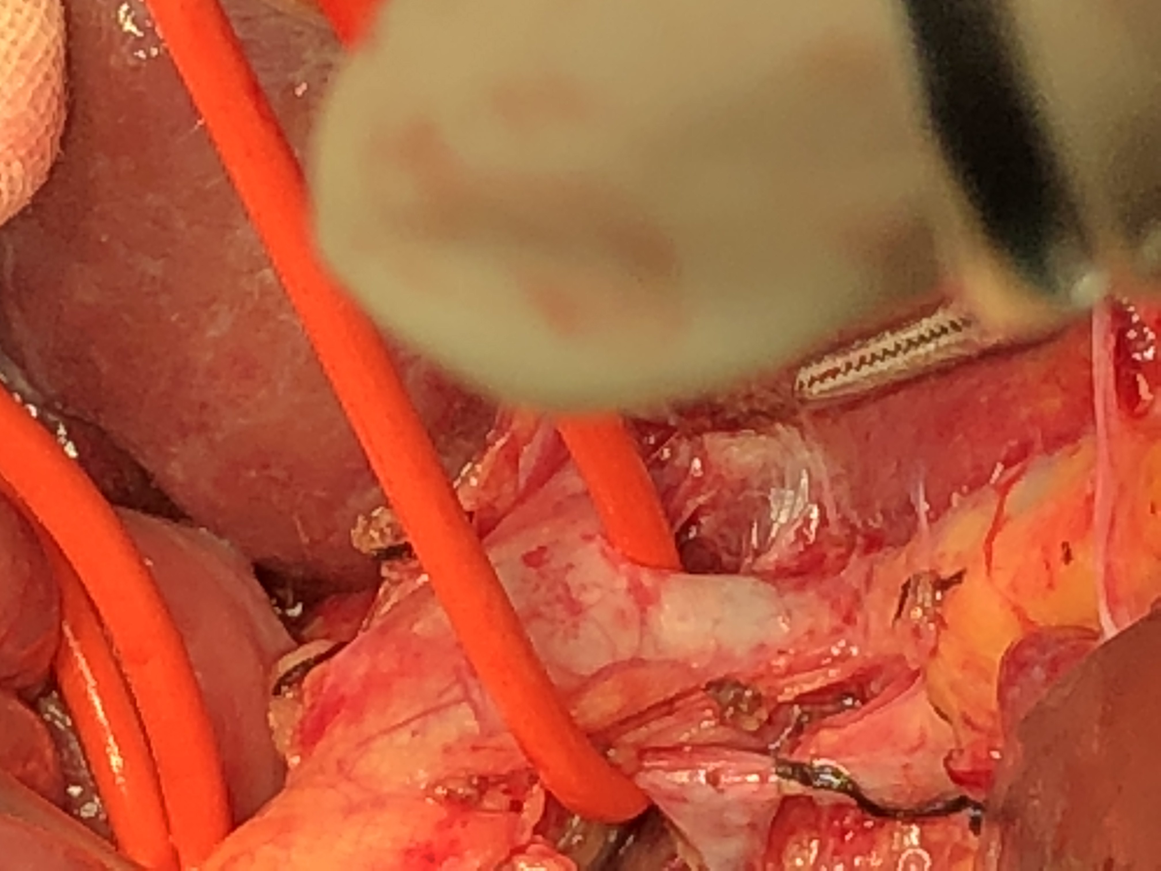 glisson鞘横断式左半肝切除术