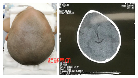 1, 额缝早闭典型的表现为三角头畸形,前额正中锋利的龙骨样突起,并有